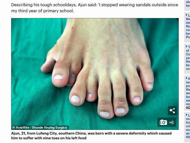 【閲覧注意】左足指が9本ある中国人男性がスゴい! コンプレックスに耐えかねて切除手術を受けたら…!の画像2