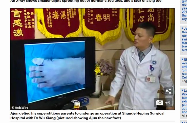 【閲覧注意】左足指が9本ある中国人男性がスゴい! コンプレックスに耐えかねて切除手術を受けたら…!の画像4