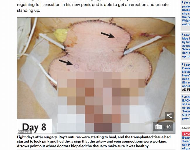 【閲覧注意】ペニス移植手術の過程がわかる画像がヤバすぎる！ 勃起も排尿もできる新しい陰茎に患者大満足＝米の画像1