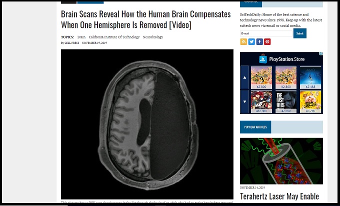 脳がカラッポの公務員がいる…人間の脳みそを半分取り除くと何が起きるのか？ 驚愕の事実判明！の画像1
