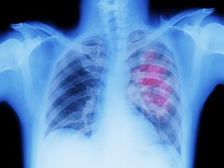 たった1秒の「肺がんセルフチェック法」とは？ 医師も推奨「シャムロス・ウィンドウ・テスト」