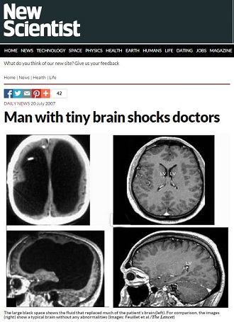脳がカラッポの公務員がいる…人間の脳みそを半分取り除くと何が起きるのか？ 驚愕の事実判明！の画像3