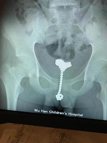 レントゲン写真が「ジャンジャンバリバリ」状態! 10代少年、尿道に磁石の玉を大量に入れて大出血!の画像2
