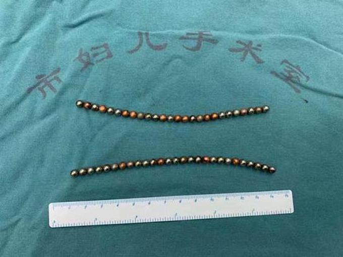 レントゲン写真が「ジャンジャンバリバリ」状態! 10代少年、尿道に磁石の玉を大量に入れて大出血!の画像3