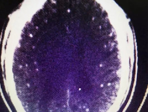 2ページ目 閲覧注意 全身に寄生虫がびっしり トラウマ級の衝撃画像も 火鍋で生煮え肉を食べた中国人男性ｰトカナ