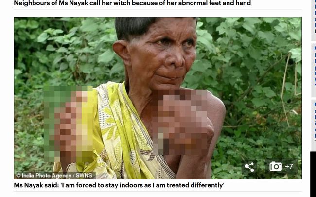 【閲覧注意】足指19本、手指12本で生まれた女の悲劇的半生！ 多指症患者を魔女扱いする農村の深い闇＝インドの画像1