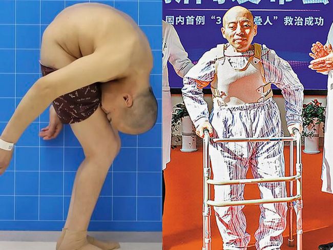 【閲覧注意】「折り畳まれた男」がハンパなく悲惨！ 太ももと顔面がくっついて20年、背骨を折る難手術の末に…＝中国の画像1
