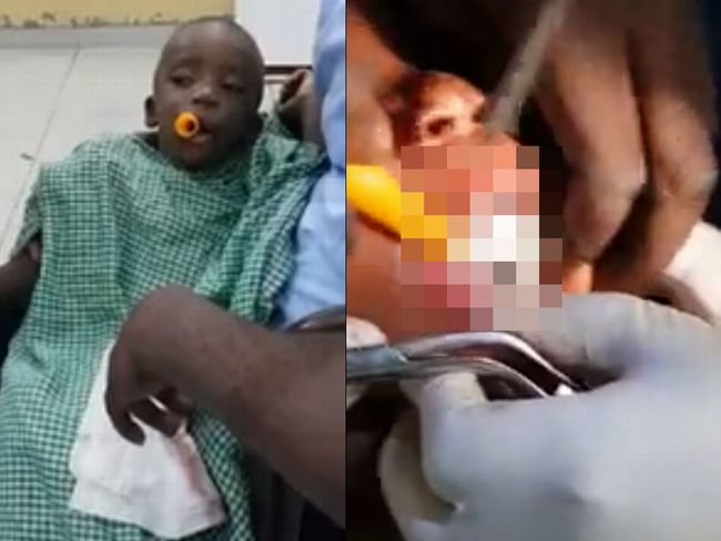 【閲覧注意】喉におもち（ゃ）が詰まるとこうなる！ 息をするたびピーピー音が… 子供の誤飲事故が恐ろしい＝ナイジェリアの画像1