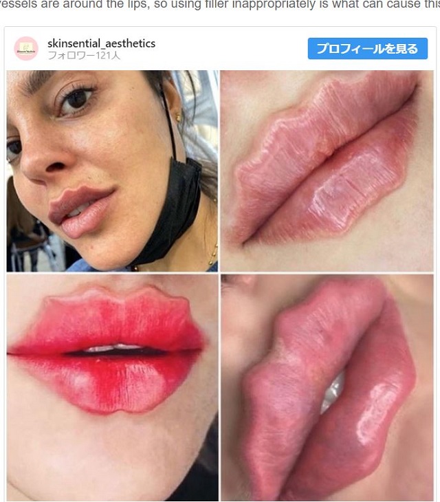 おそロシア発! ギザギザの唇「ウェービー・リップ」が最新ビューティートレンド…別名「タコの吸口」女が増殖!?の画像2