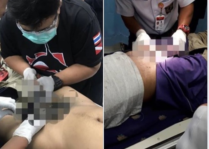 悲劇のオナニー事故が発生! タイの青年、ホースからイチモツが抜けなくなり、根本から切除か!の画像2