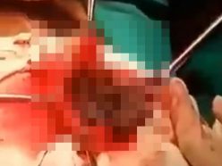 【閲覧注意】「異食症」患者の最恐・手術映像が公開されてしまう！ 胃の中から“信じられない”ものが次々と…＝インド