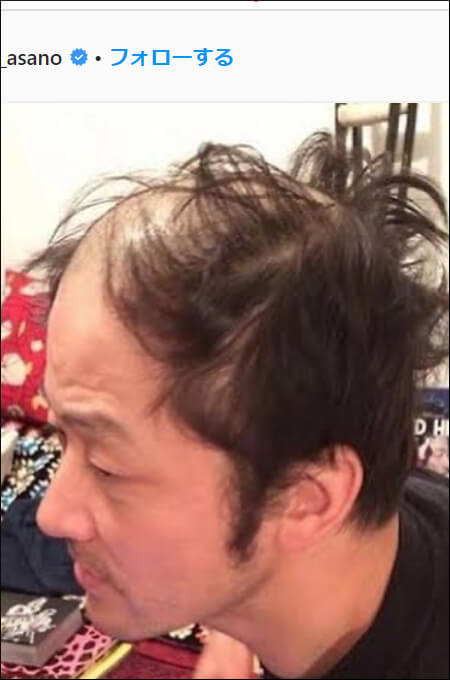 松坂桃李のおでこがやばい?「想像以上の進行…」毛量が不安視される芸能人4人!の画像4