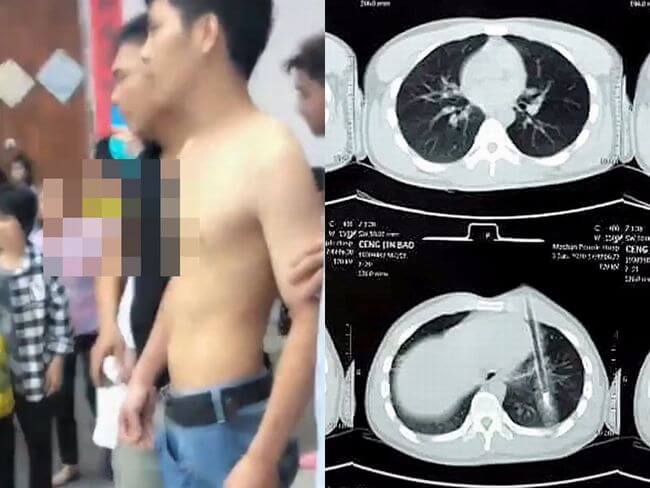 【閲覧注意】悲惨なボウガン事件が中国でも発生! 矢が刺さった人間はこうなる… 引き抜いたら死にそうな姿に衝撃=中国の画像1