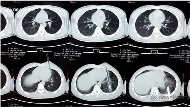 【閲覧注意】悲惨なボウガン事件が中国でも発生! 矢が刺さった人間はこうなる… 引き抜いたら死にそうな姿に衝撃=中国の画像6
