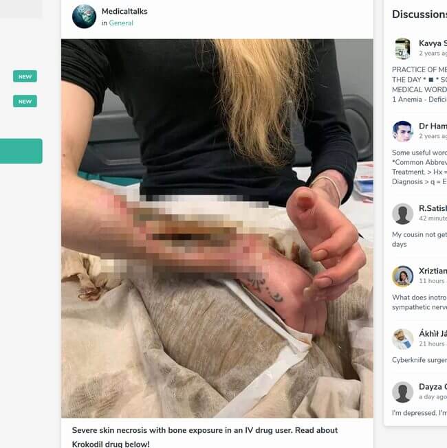 【閲覧注意】史上最凶ドラッグ「クロコダイル」にハマった女の腕が超エグい! 骨が剥き出し、悪臭を放ち… 「人喰い薬物」の恐怖の画像1