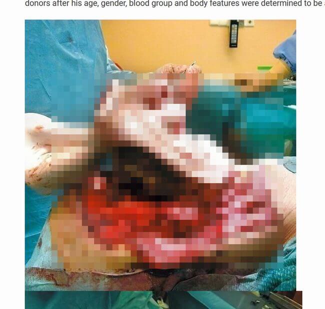 【超・閲覧注意】顔をパカッと付け替える「恐怖の顔面移植手術」画像が流出! 映画のワンシーンではない、衝撃的光景!の画像1