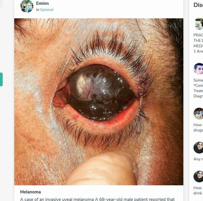【閲覧注意】白目が完全消失して「眼球が真っ黒になる」眼腫瘍が怖すぎる! リアル「黒い目の子供たち(BEK)」か!?の画像2