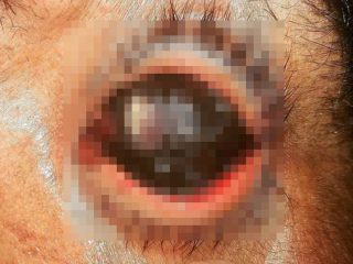 【閲覧注意】白目が完全消失して「眼球が真っ黒になる」眼腫瘍が怖すぎる！ リアル「黒い目の子供たち（BEK）」か!?