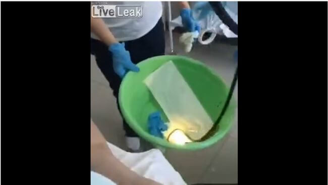 【閲覧注意】就寝中に口から「ヘビが体内に侵入してしまった」女! 医師も恐怖、衝撃の摘出映像が公開される!=ロシアの画像5