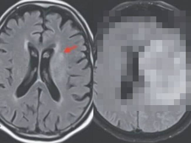 【閲覧注意】「殺人アメーバ」に感染した男、脳が溶けて死亡! 精神崩壊、壊死… コロナ禍で人気の庭いじりに潜むリスク=英の画像1