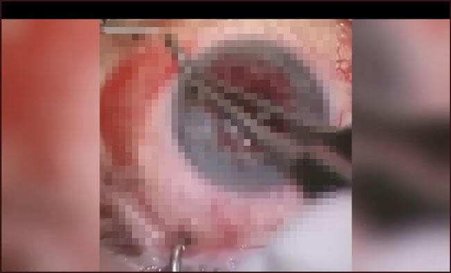 【閲覧注意】眼球にブッ刺さった釣り針を引き抜く「どアップ手術映像」がヤバすぎる!!の画像1