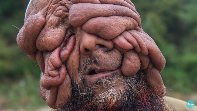 前を向いて生きる「顔のない男」 ― 苦難の果てに子ども誕生、障害を超越した夫婦の愛と奇跡=印の画像3