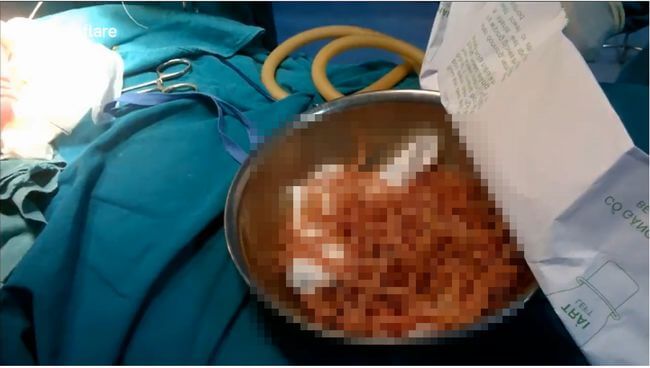 【閲覧注意】腸内で繁殖した大盛りスパゲッティがグロすぎる! 腹痛で苦しむ男の体内から寄生虫100匹を摘出=ベトナムの画像1