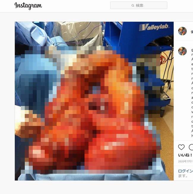 【グロ注意】腸が極限まで肥大してモンスター級に腫れ上がるとこうなる!! 恐怖の人肉ホルモン地獄!の画像1
