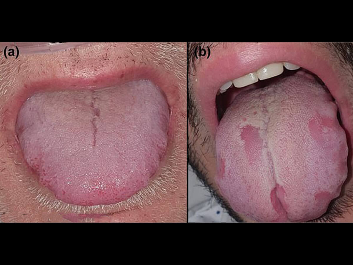 要注意 コロナ患者の多くが コロナ舌 になっていると判明 手足に斑点 発疹も 感染を見分ける新たな兆候 研究者が提言