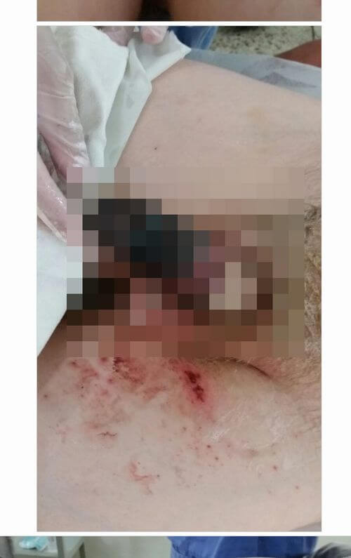 【閲覧注意】ペニスが感電して腐ったバナナになった少年!! 真っ黒焦げの男性器を根元から切断!=ブラジルの画像1