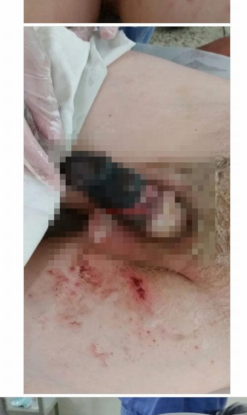 【閲覧注意】ペニスが感電して腐ったバナナになった少年!! 真っ黒焦げの男性器を根元から切断!=ブラジルの画像3
