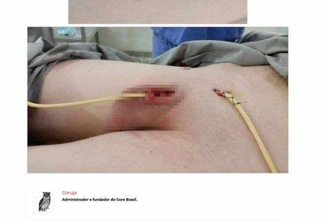【閲覧注意】ペニスが感電して腐ったバナナになった少年!! 真っ黒焦げの男性器を根元から切断!=ブラジルの画像4