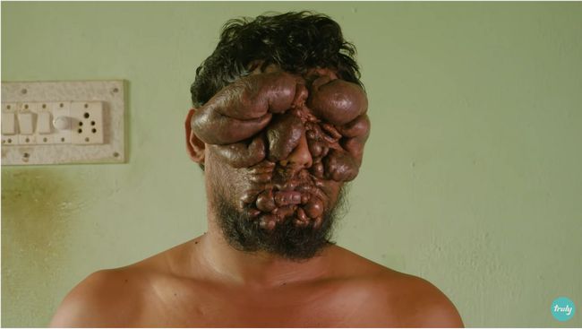 顔面を「腫瘍に占領された」男が悲しすぎる！ 小さなニキビがどんどん巨大化＆増殖、視力も失い… ようやく差した希望の光＝インドの画像1