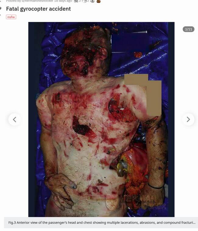 【超・閲覧注意】ヘリコプター墜落事故の犠牲者が悲惨すぎる! 全身バキバキ、骨が粉砕、内臓ぶちまけ… 衝撃の強さを物語る肉塊の画像4