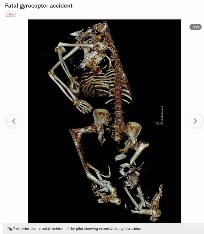 【超・閲覧注意】ヘリコプター墜落事故の犠牲者が悲惨すぎる! 全身バキバキ、骨が粉砕、内臓ぶちまけ… 衝撃の強さを物語る肉塊の画像8