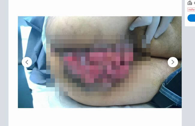 【閲覧注意】肛門を覆い尽くすカリフラワーがヤバすぎる!! 性病「尖圭コンジローマ」が極限悪化した恐怖画像7選!の画像1