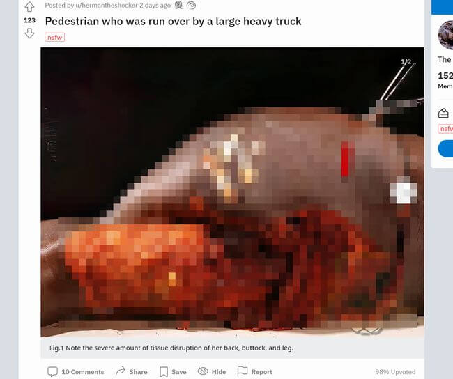 【超・閲覧注意】大型トラックにスライスされた歩行者の臀部！ 内部組織が全露出… 「広範囲皮膚剥脱」の恐怖！の画像1