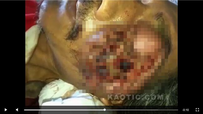 【超・閲覧注意】左頬がウジ虫の巣になった男! 蠢く無数の白い生物… 鳥肌必至の蝿蛆症映像!の画像1