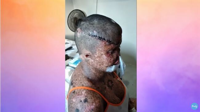 日光を浴びて全身がんになった女性の悲哀!! 手術200回以上、引きこもり生活… 色素性乾皮症と戦いながら前向きに生きる=ブラジルの画像5