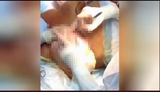 【閲覧注意】巨乳を小さくする手術映像がヤバすぎる! 乳首・乳輪の周りに… むき出しの組織が…!の画像1