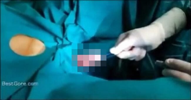 【閲覧注意】「尿道オナニー」禁断の快感がもたらす代償 ペニスから引き抜かれた●●がヤバい! の画像1