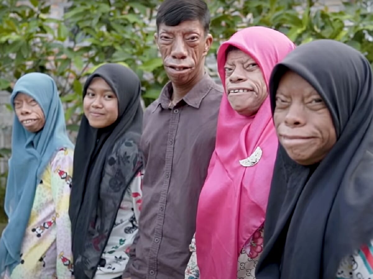 一家全員の顔の変形が止まらない シェイプシフト家族 まったく原因不明の未知の病 インドネシア