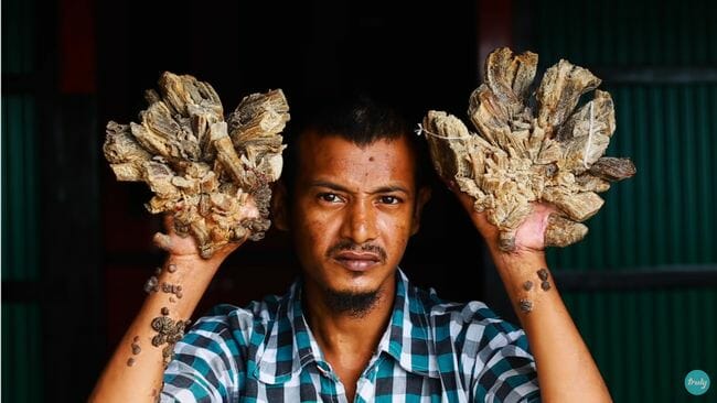 手足が樹木に変わりゆく「ツリーマン」の悲哀！ 貧困・偏見に屈せず、愛と希望を胸に歩む力強い人生＝バングラデシュの画像1