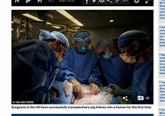 【手術映像】世界初、ブタの腎臓をヒトに移植成功、公開された映像が本気でヤバい！＝米の画像1