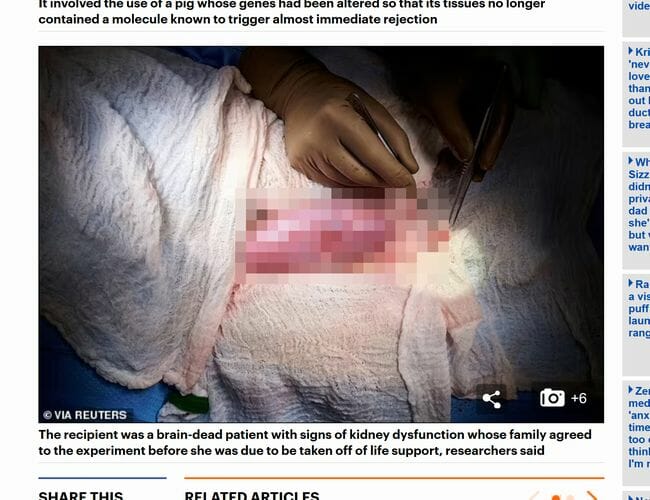 【手術映像】世界初、ブタの腎臓をヒトに移植成功、公開された映像が本気でヤバい!=米の画像2