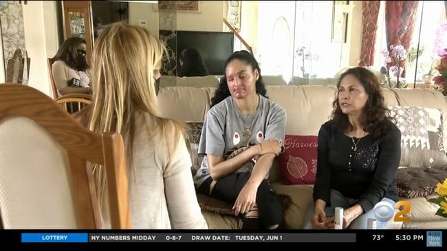 アシッドアタックで顔面が溶けた美人女子大生! アジア系に対する憎悪と戦い抜く覚悟=米の画像4