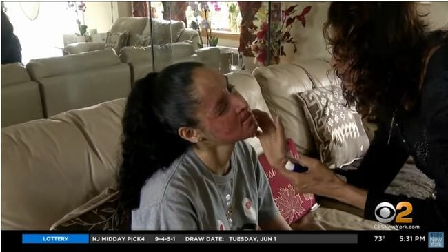 アシッドアタックで顔面が溶けた美人女子大生! アジア系に対する憎悪と戦い抜く覚悟=米の画像5