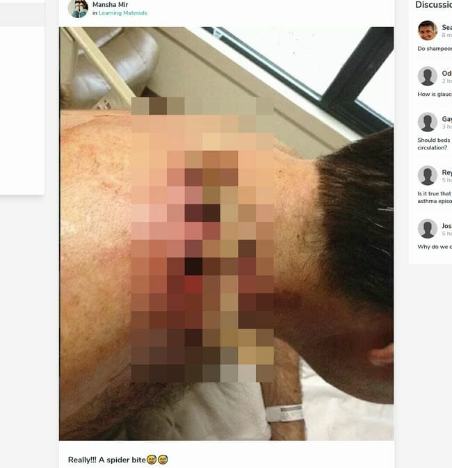 【閲覧注意】クモに咬まれただけで体に穴が空いた男がヤバい! 毒液による壊死か、医学メディア掲載の画像1