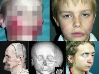 形成外科は顔をどこまで修復できるのか？ 学術誌掲載「顔面再建手術」の驚異的事例5選