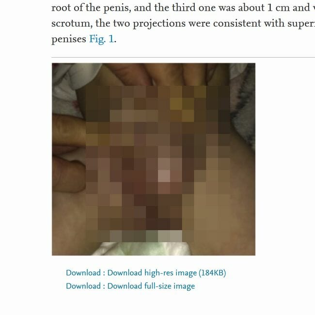【史上初】ペニスが3本ある赤ん坊が医学誌で報告される！ 極めて珍しい「陰茎重複症」手術の結果は…!?の画像1